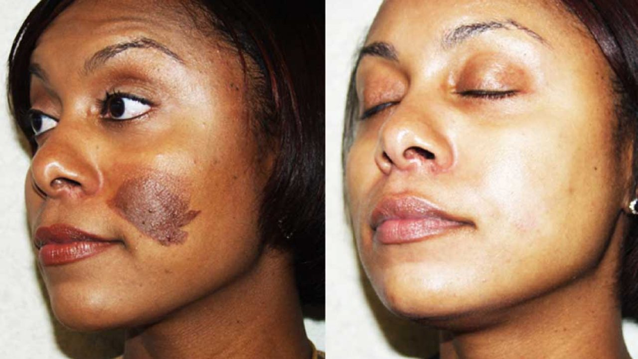 How To Get Rid Of Burn Scars On Face GLAMSQUAD MAGAZINE