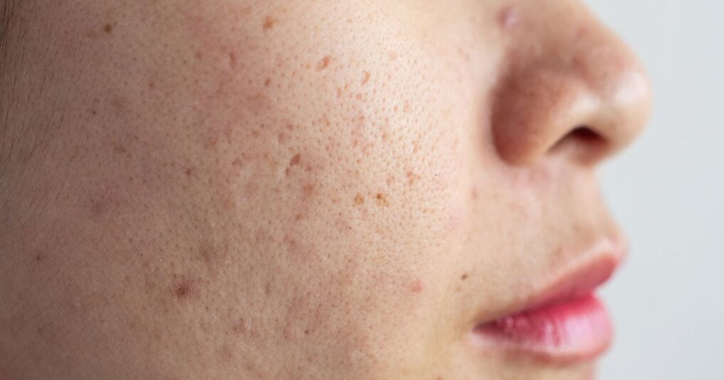 How To Get Rid Of Burn Scars On Face GLAMSQUAD MAGAZINE